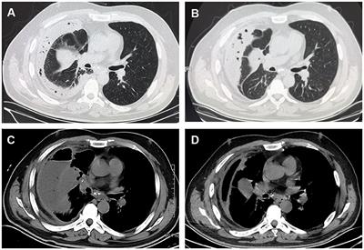 Empyema caused by Fusobacterium nucleatum with squamous cell carcinoma of the lung: a case report and literature review